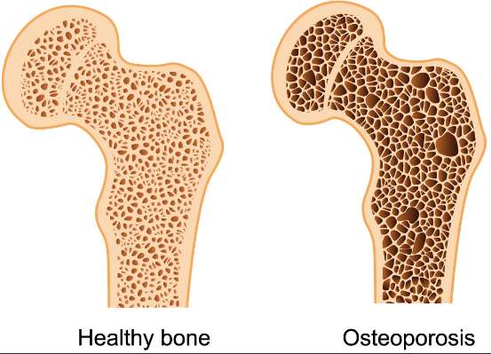 Comparison between a healthy bone versus a bone with osteoporosis Osteoporosis bones